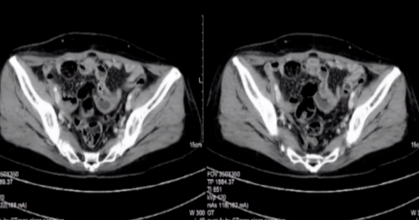 卵巢癌風險評估系統(tǒng)?